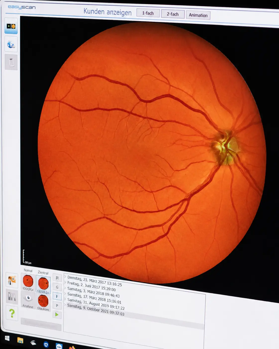 schütt optik hörakustik ludwigsburg auswirkung bluthochdruck sehleistung dein auge