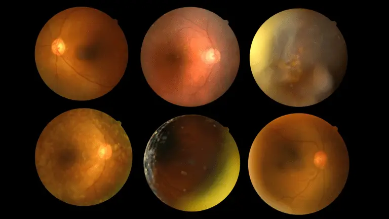 Sch&uuml;tt Optik H&ouml;rakustik Ludwigsburg Wissen Diabetische Retinopathie